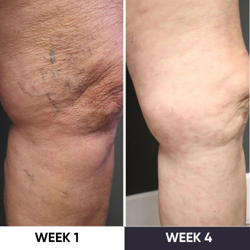 VeinVanish Pro - Say Hello To Beautiful Legs