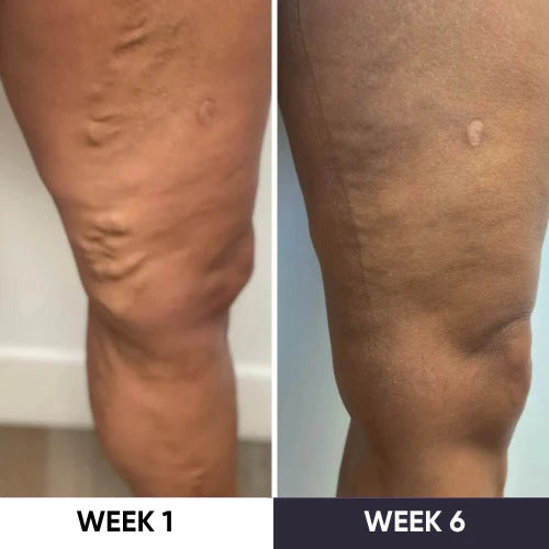 VeinVanish Pro - Say Hello To Beautiful Legs